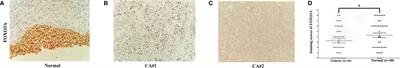 FOXO3A Expression in Upper Tract Urothelial Carcinoma